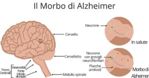 malattia-alzheimer